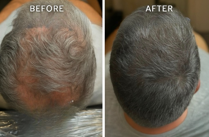 Before and After SMP Treatment
