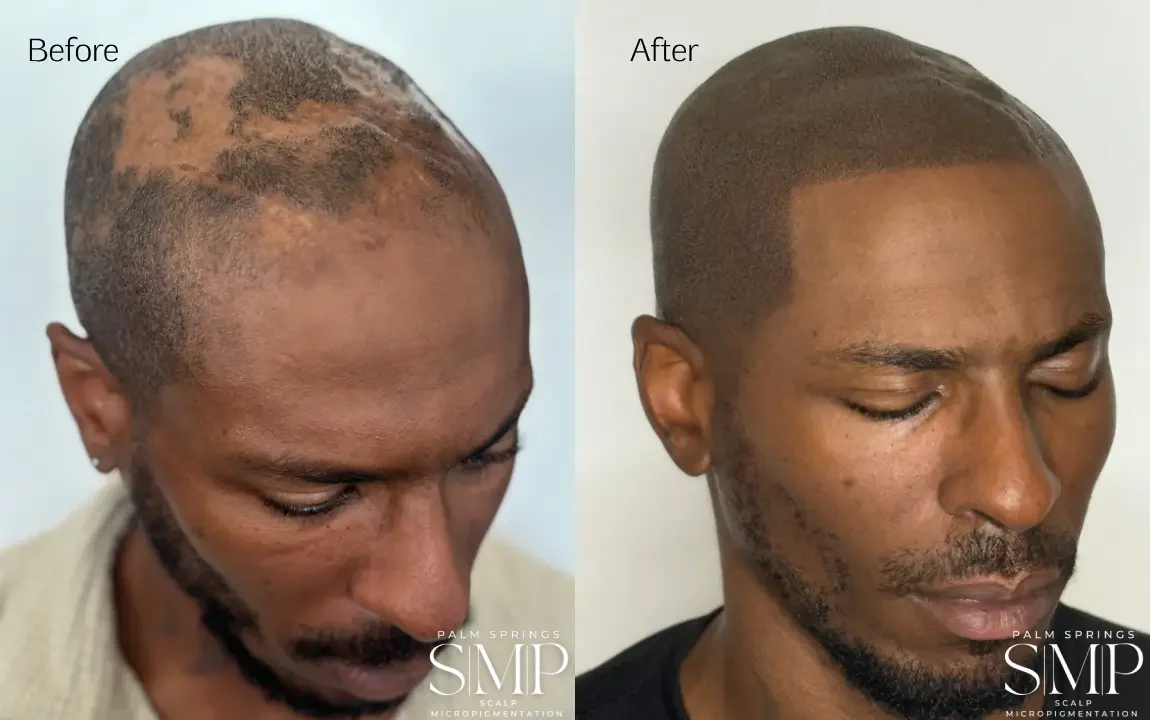 Alopecia